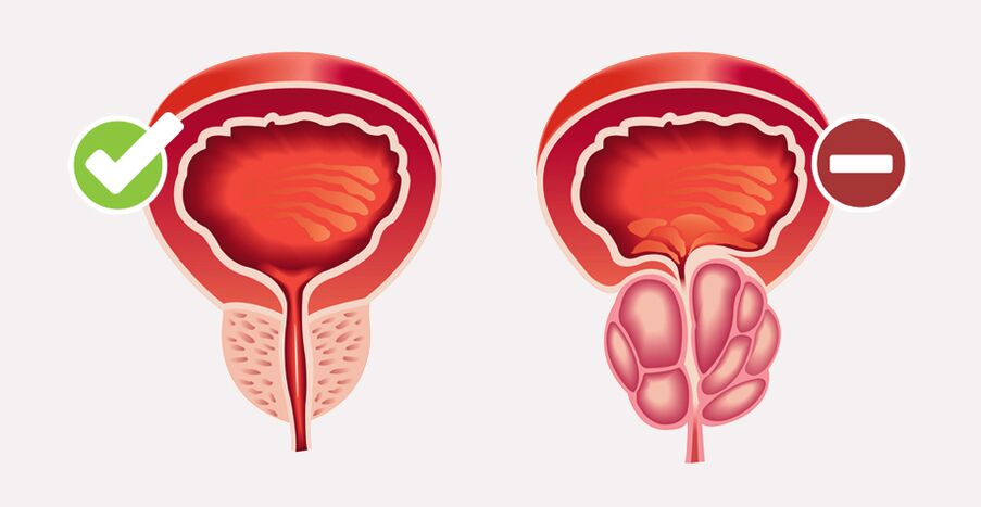 Weiprost normalizuoja prostatos dydį ir funkciją