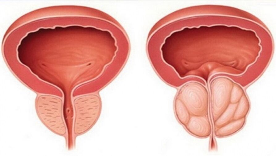 sveika ir uždegusi prostata su prostatitu