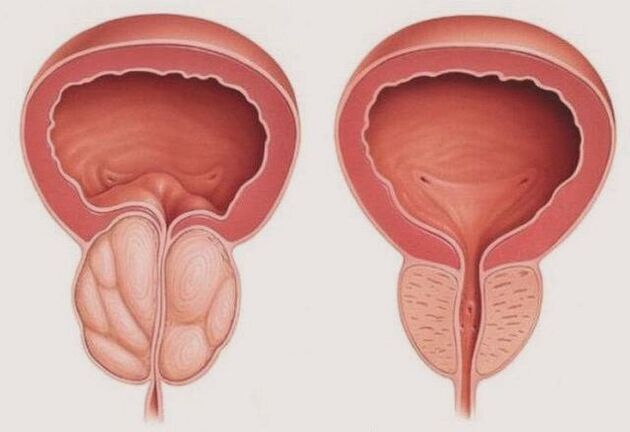 sveika ir uždegusi prostata su prostatitu