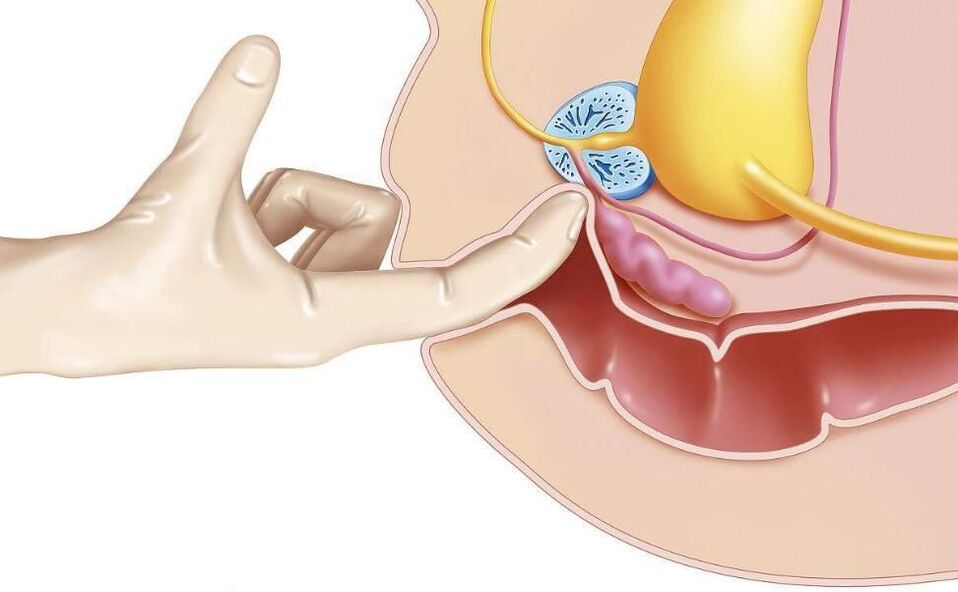 prostatos masažas prostatito gydymui